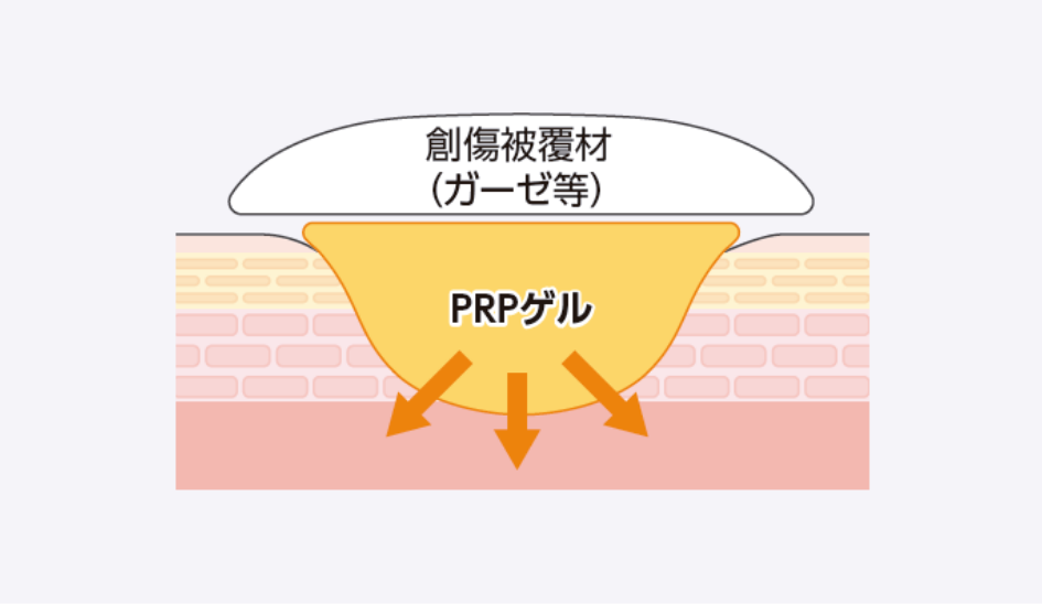 PRPゲルに含まれる成長因子が創傷に供給され、創傷治癒を促進させる。